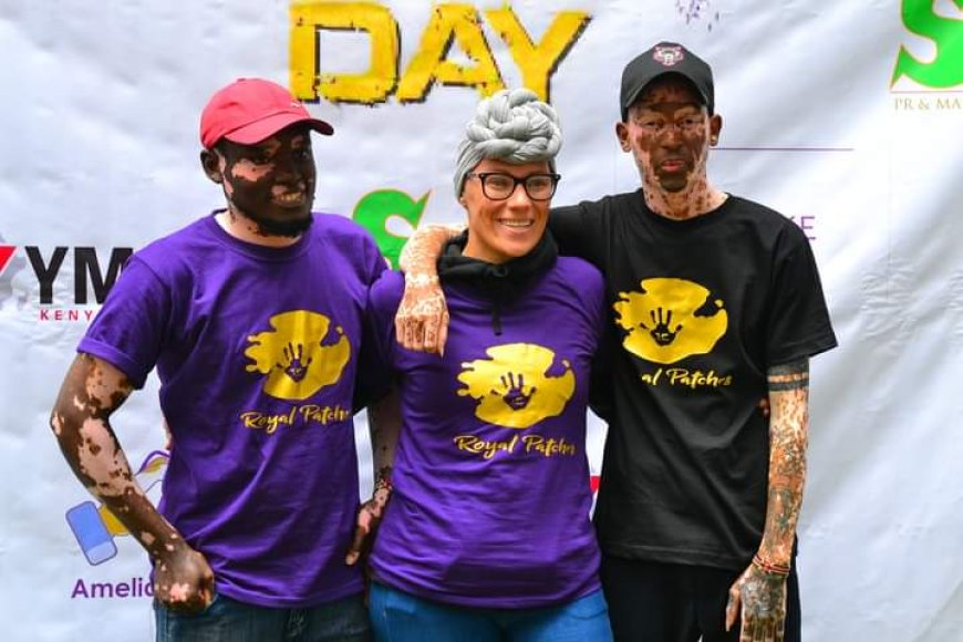 World Vitiligo awareness Day observed