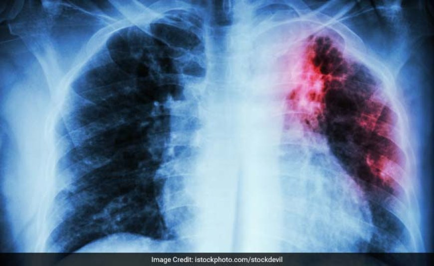 Family Members Asked To Be Cautious When Handling TB Patients