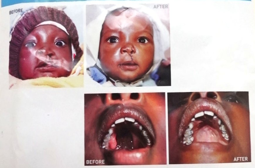 Embu children get free cleft lip and Palate surgeries