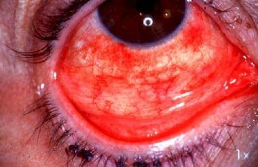 Tanzania issues high alert over red eye disease outbreak