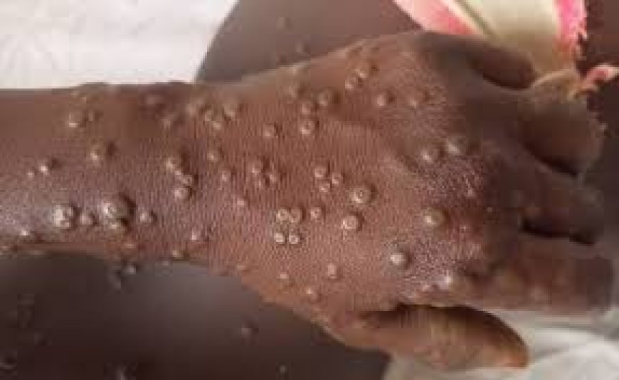 Ministry of health confirms outbreak of Mpox in the country