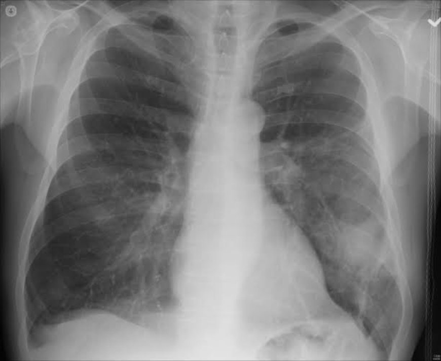 Understanding Pneumonia, The Silent Lung Killer